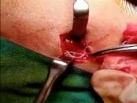 کرم زنده داخل صورت