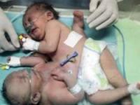 دوقلوی بهم چسبیده