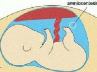 خطرات آمنیوسنتز