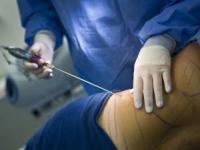 عمل جراحی لیپوساکشن