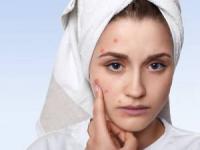 قرص آکنه