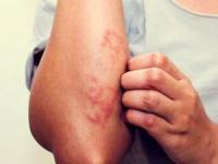 درمان اگزما