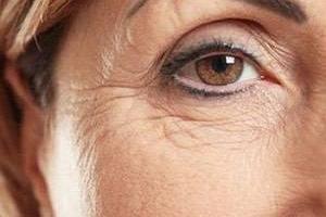 چین و چروک دور چشم