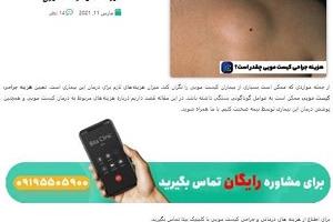 هزینه عمل کیست مویی