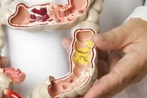 آی بی اس روده