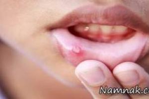 زخم های دهان