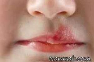 درمان سریع تبخال