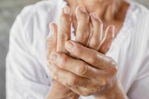 آرتریت روماتوئید