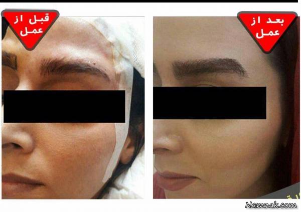 کاشت ابرو روی تاتو کلینیک آریا