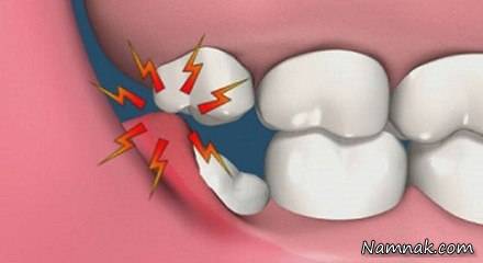 زمان کشیدن دندان عقل