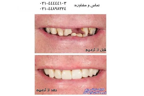 لمینیت دندان