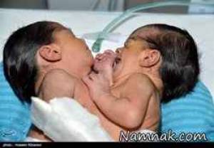 دوقلوهای به هم چسبیده ، دوقلو