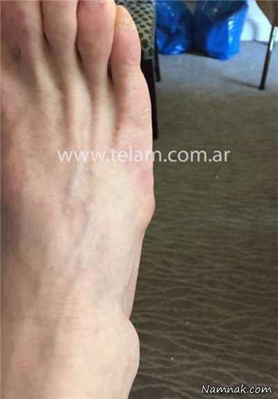 پای ملتهب و مصدوم لیونل مسی پای لیونل مسی