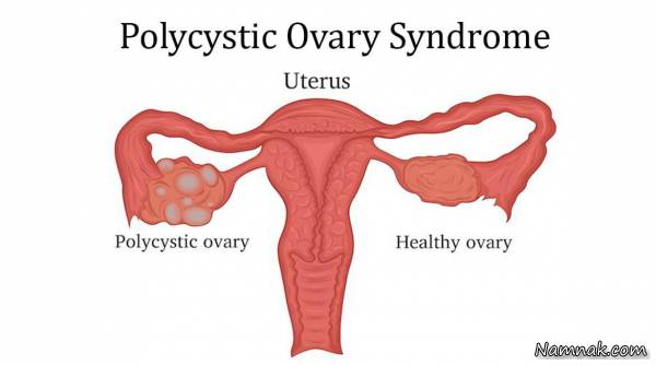 تفاوت تخمدان سالم و تخمدان دارای سندروم pcos
