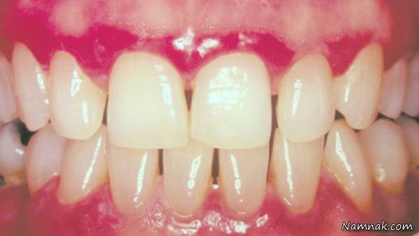 درمان ورم لثه دندان