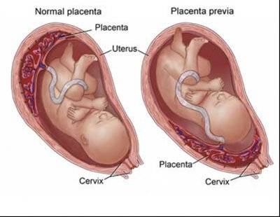 جفت سر راهی یا پایین چیست و چه علل و علائمی دارد؟