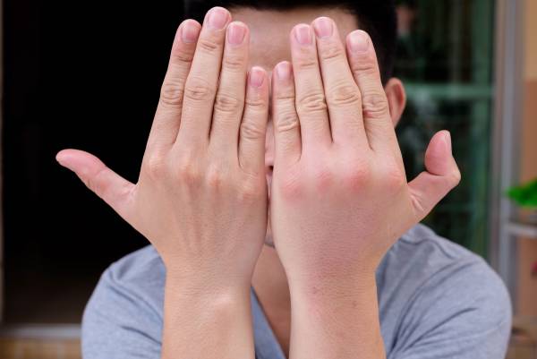 ورم دست و پا چه علتی دارد؟ علل ورم دست و پا