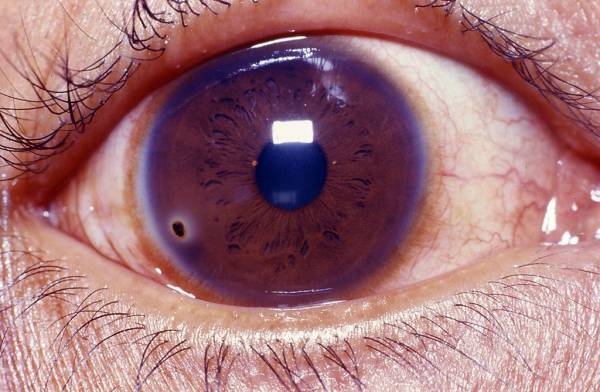 خراشیدگی چشم به چه دلیلی پدید می آید؟ حساسیت چشم به نور و تاری بینایی