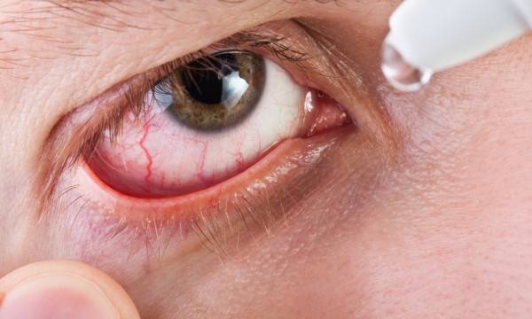 درمان خراشیدگی قرنیه چشم رفع خراشیدگی قرنیه