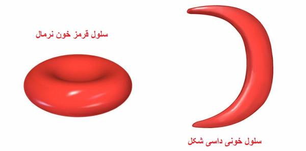 کم خونی داسی