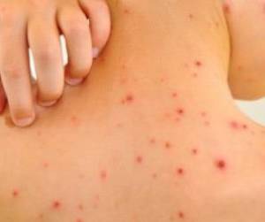 بیماری مورژلونز ، علائم بیماری مورژلونز