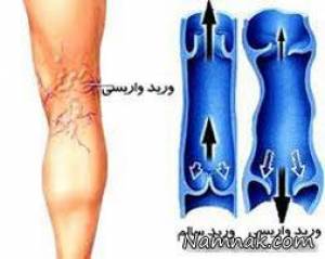 واریس ، بیماری