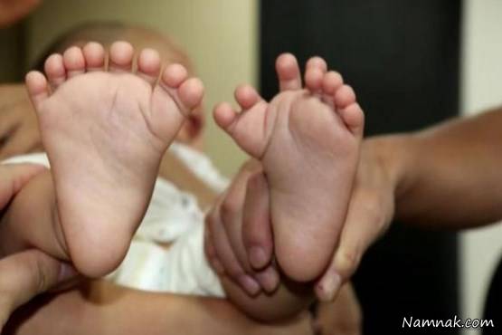 تصاویر جنجالی از تولد نوزاد 31 انگشتی در چین + تصاویر