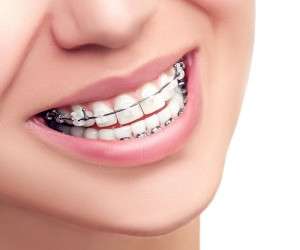 انواع ارتودنسی ، ارتودنسی ها