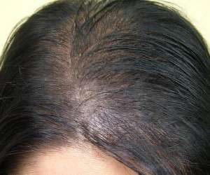 کچلی و ریزش مو