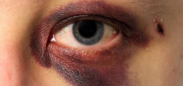 درمان کبودی و سیاهی چشم