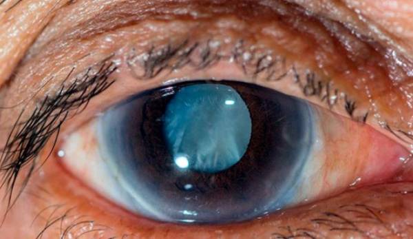 جلوگیری از بیماری گلوکوم آب سیاه گلوکوم