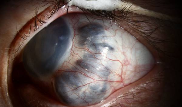 انواع آب سیاه گلوکوم آب سیاه گلوکوم