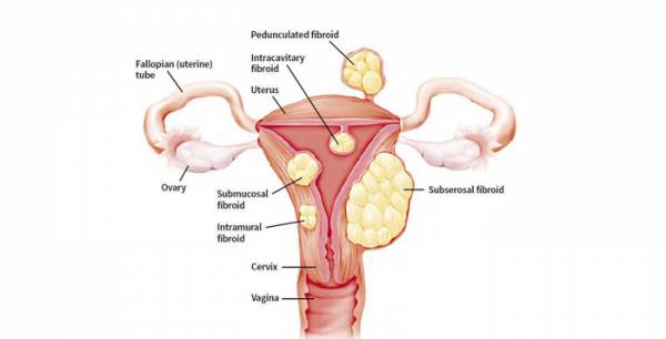 تشخیص فیبروئیدهای رحمی روش تشخیص فیبروئیدهای رحمی