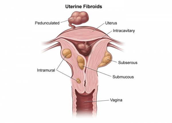 درمان های فیبروم رحمی درمان های فیبروم رحم