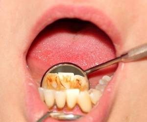 رفع پلاک دندان ، درمان طبیعی جرم دندان