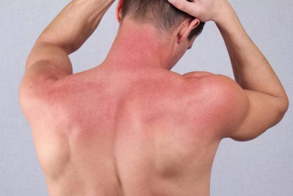 سیب زمینی برای درمان آفتاب سوختگی درمان آفتاب سوختگی با سیب زمینی