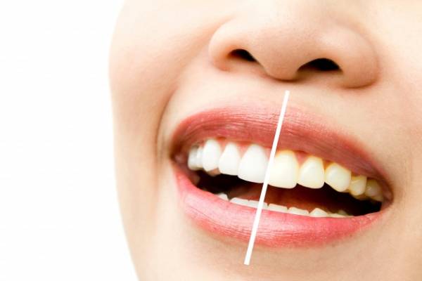 بهبود آبسه دندان 