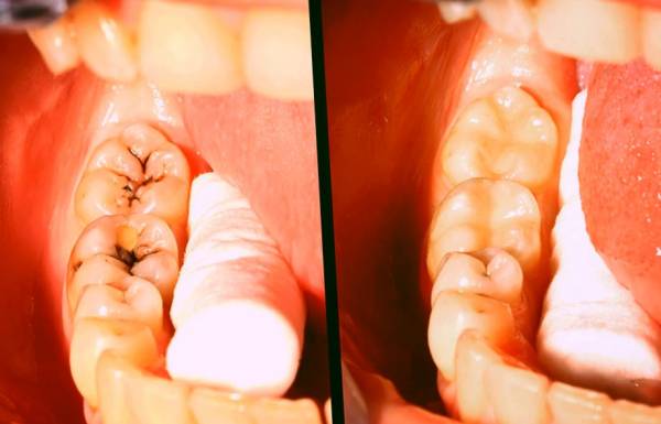 علت و پیشگیری و درمان پوسیدگی دندان