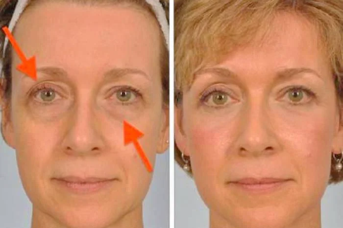 درمان سریع و ارزان افتادگی پلک افتادگی پلک