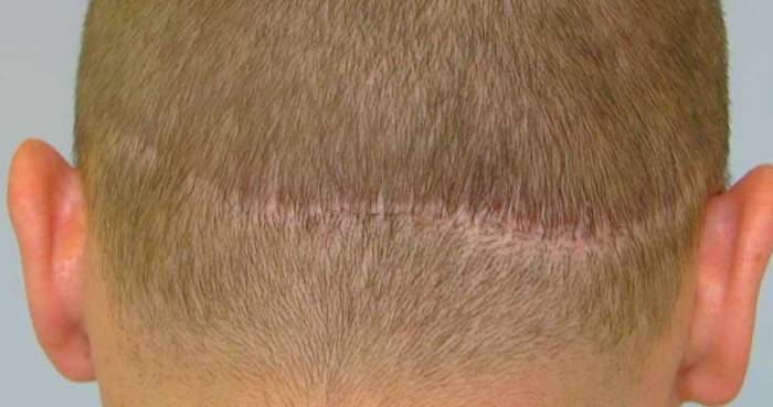 عوارض بعد از کاشت مو