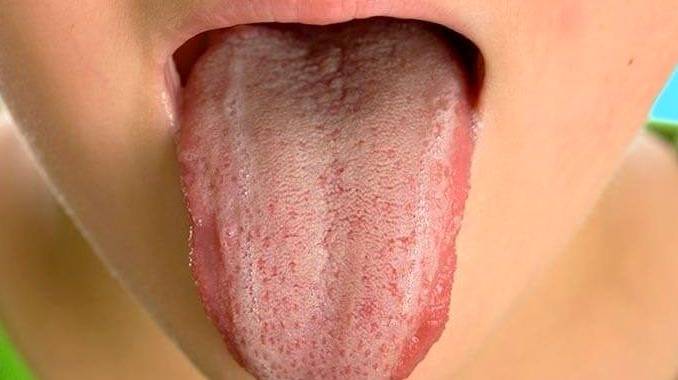 درمان بار زبان
