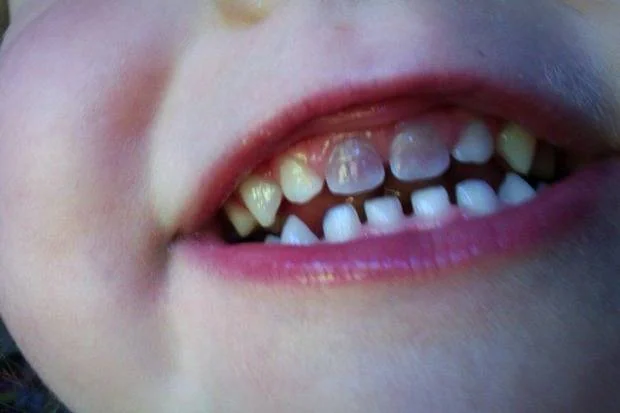 لکه روی دندان کودک تغییر رنگ دندان نوزاد