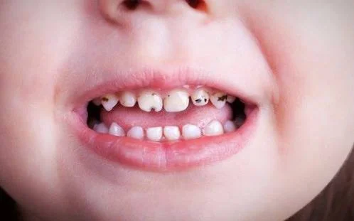 درمان تغییر رنگ دندان جلوگیری از تغییر رنگ دندان