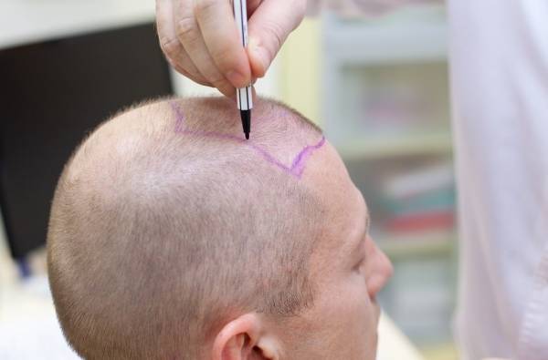 درمان عفونت بعد از کاشت مو