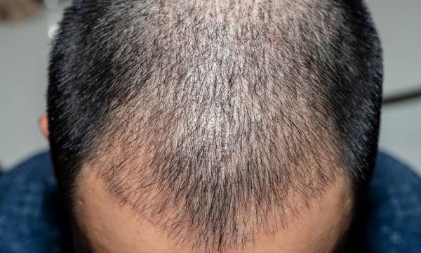 نشانه های عفونت بعد از کاشت مو
