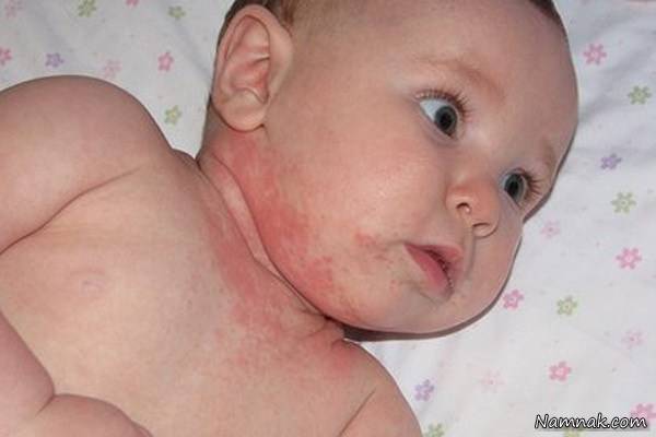 آلرژی نوزادان