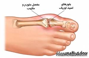 علائم نقرس