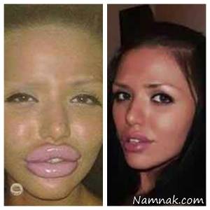 زشت شدن دختر زیبا با جراحی پلاستیک