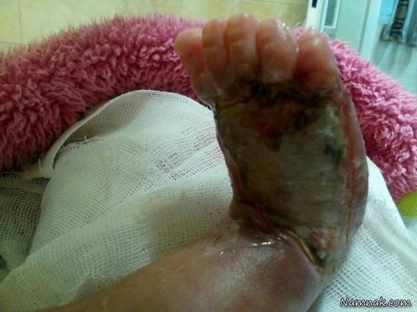سوختن پای نوزاد
