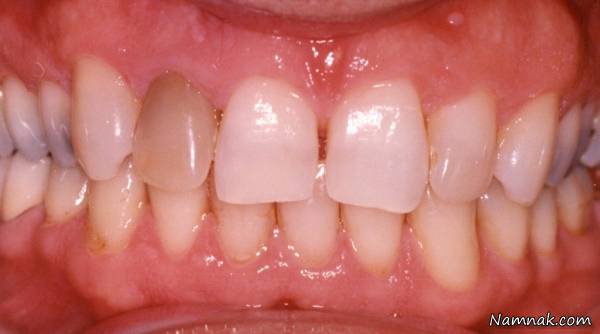 %D9%84%DA%A9%D9%87 %D8%AF%D9%86%D8%AF%D8%A7%D9%86 - علت اصلی لکه دار شدن دندان ها